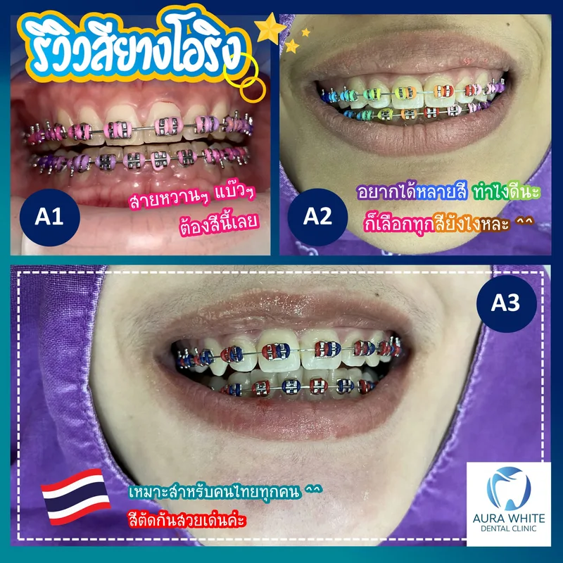 ภาพในช่องปากรีวิวสียางโอริงจัดฟันหลายเฉดสี สีชมพู สีรุ้ง และสีน้ำเงินแดง คลินิกทันตกรรม AuraWhite บางพลี