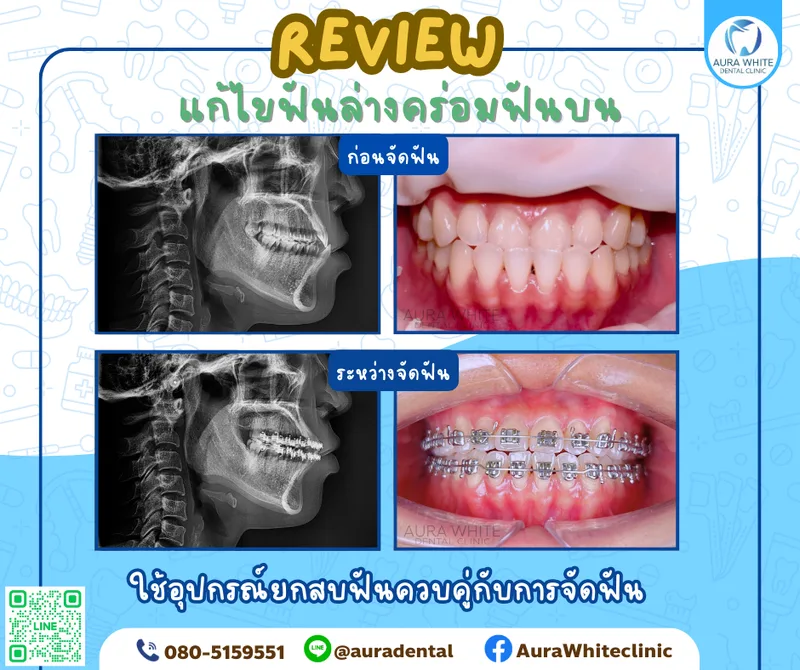 รีวิวเคสจัดฟันแก้ไขฟันล่างคร่อมฟันบน ภาพเอกซเรย์ด้านข้างและภาพในช่องปากก่อนและระหว่างจัดฟัน คลินิกทันตกรรม AuraWhite บางพลี