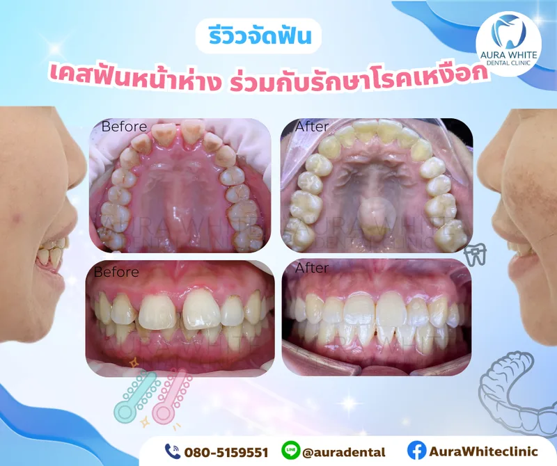 รีวิวจัดฟันเคสฟันหน้าห่างร่วมกับรักษาโรคเหงือก ภาพในช่องปากด้านบนและด้านหน้าก่อนและหลังรักษา คลินิกทันตกรรม AuraWhite บางพลี