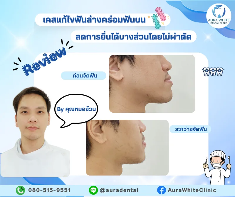 รีวิวเคสจัดฟันแก้ไขฟันล่างคร่อมฟันบน ภาพด้านข้างใบหน้าก่อนและระหว่างจัดฟันโดยทันตแพทย์ คลินิกทันตกรรม AuraWhite บางพลี