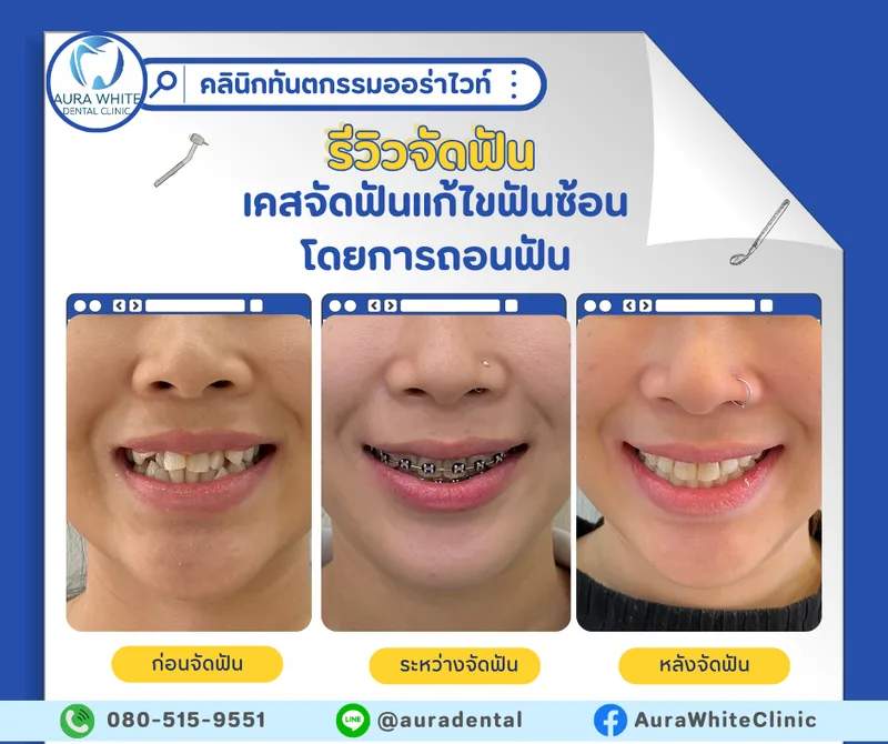 รีวิวจัดฟันเคสแก้ไขฟันซ้อนโดยการถอนฟัน ภาพรอยยิ้มก่อน ระหว่าง และหลังจัดฟัน คลินิกทันตกรรม AuraWhite บางพลี