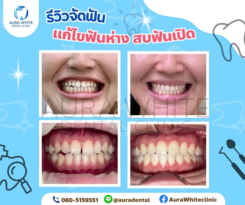 รีวิวจัดฟันเคสแก้ไขฟันห่างและสบฟันเปิด ภาพรอยยิ้มและภาพในช่องปากก่อนและหลังรักษา คลินิกทันตกรรม AuraWhite บางพลี