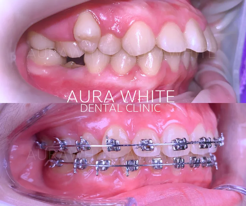 เคสจัดฟันแก้ฟันซ้อนเกทั้งปาก คลินิกทันตกรรม AuraWhite บางพลี