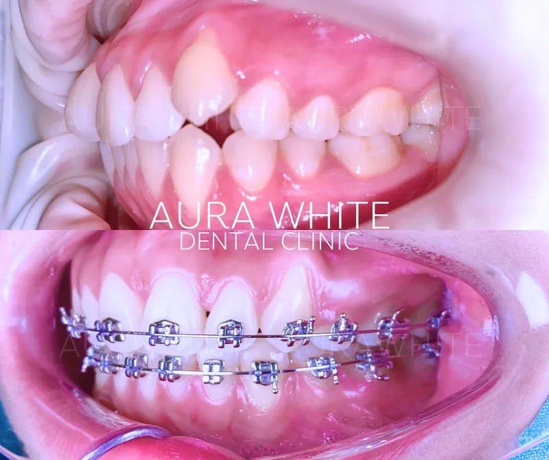 เคสจัดฟันแก้ฟันห่างหน้าบน คลินิกทันตกรรม AuraWhite บางพลี