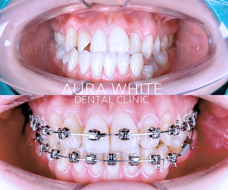เคสจัดฟันแก้ฟันสบเปิด คลินิกทันตกรรม AuraWhite บางพลี