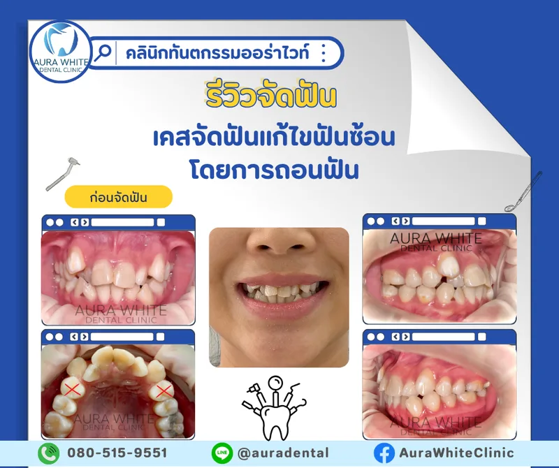 กราฟิกรีวิวเคสจัดฟันแก้ฟันซ้อนโดยการถอนฟัน รวมภาพในช่องปากหลายมุมก่อนจัดฟัน คลินิกทันตกรรม AuraWhite บางพลี