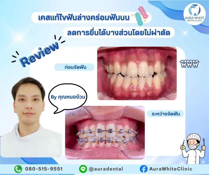 เคสจัดฟันแก้ไขฟันล่างคร่อมฟันบน เปรียบเทียบก่อนจัดฟันและระหว่างจัดฟันด้วยเครื่องมือโลหะ คลินิกทันตกรรม AuraWhite บางพลี