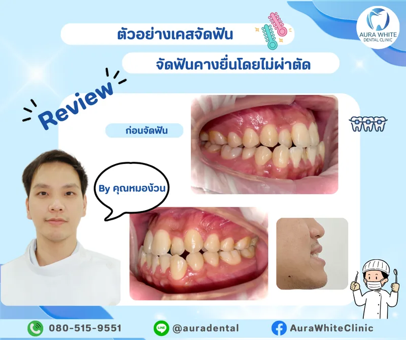 เคสจัดฟันแก้คางยื่นโดยไม่ผ่าตัด ภาพในช่องปากด้านข้างก่อนจัดฟันและภาพด้านข้างใบหน้า คลินิกทันตกรรม AuraWhite บางพลี
