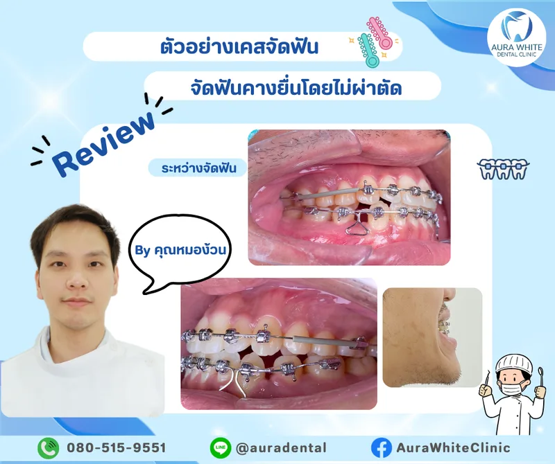 เคสจัดฟันแก้คางยื่นโดยไม่ผ่าตัด ภาพในช่องปากระหว่างจัดฟันพร้อมยางดึงฟัน คลินิกทันตกรรม AuraWhite บางพลี
