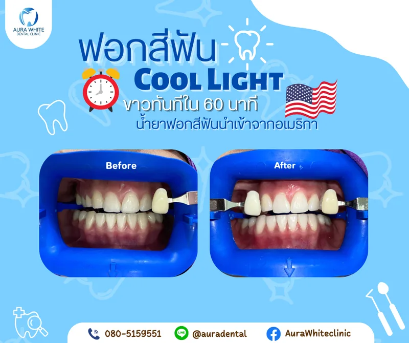 เคสฟอกสีฟัน Cool Light เปรียบเทียบสีฟันก่อนและหลังฟอกด้วยแถบเทียบสี คลินิกทันตกรรม AuraWhite บางพลี