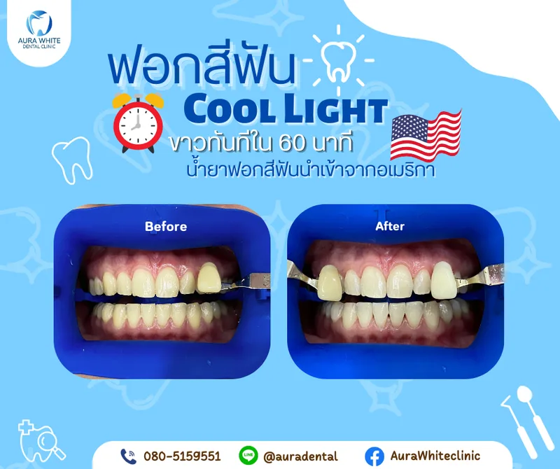 เคสฟอกสีฟัน Cool Light เปรียบเทียบก่อนและหลังฟอก ฟันขาวขึ้นหลายระดับ คลินิกทันตกรรม AuraWhite บางพลี