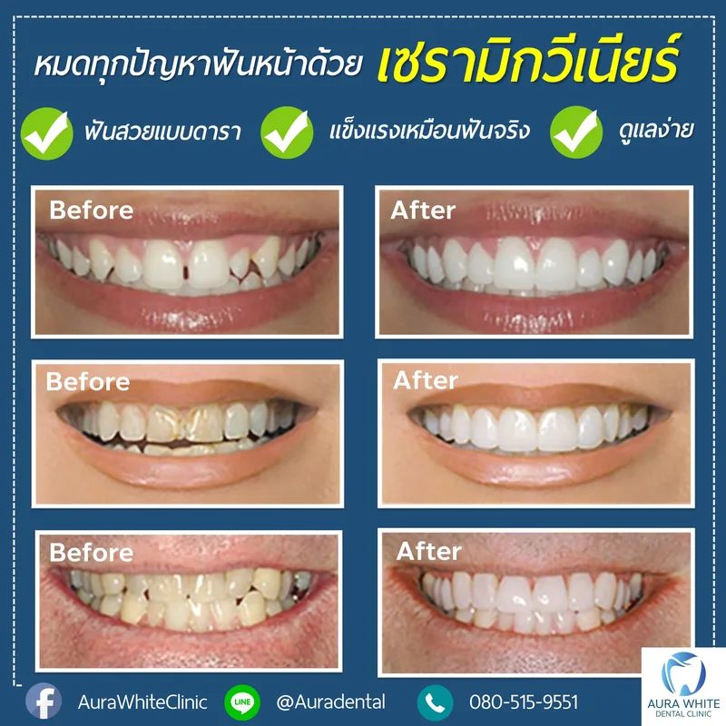 เคสเซรามิกวีเนียร์ ภาพก่อนและหลัง 3 คู่ แก้ปัญหาฟันหน้าเหลืองและสึก คลินิกทันตกรรม AuraWhite บางพลี