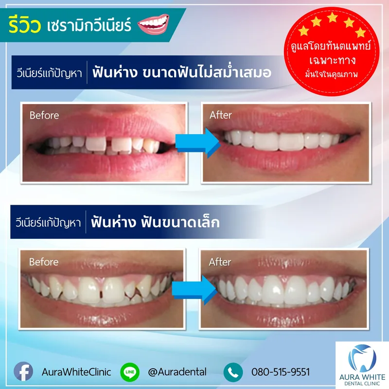 เคสเซรามิกวีเนียร์แก้ฟันห่างและฟันขนาดไม่สม่ำเสมอ ภาพก่อนหลัง 2 คู่ คลินิกทันตกรรม AuraWhite บางพลี