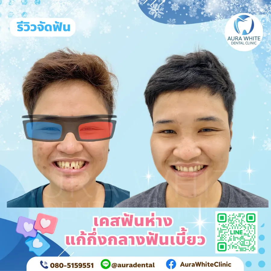 รีวิวเคสฟันห่าง แก้ฟันกลางหน้าเปิด AuraWhite