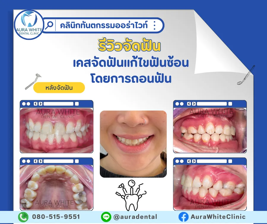 รีวิวเคสจัดฟันแก้ไขฟันซ้อน AuraWhite