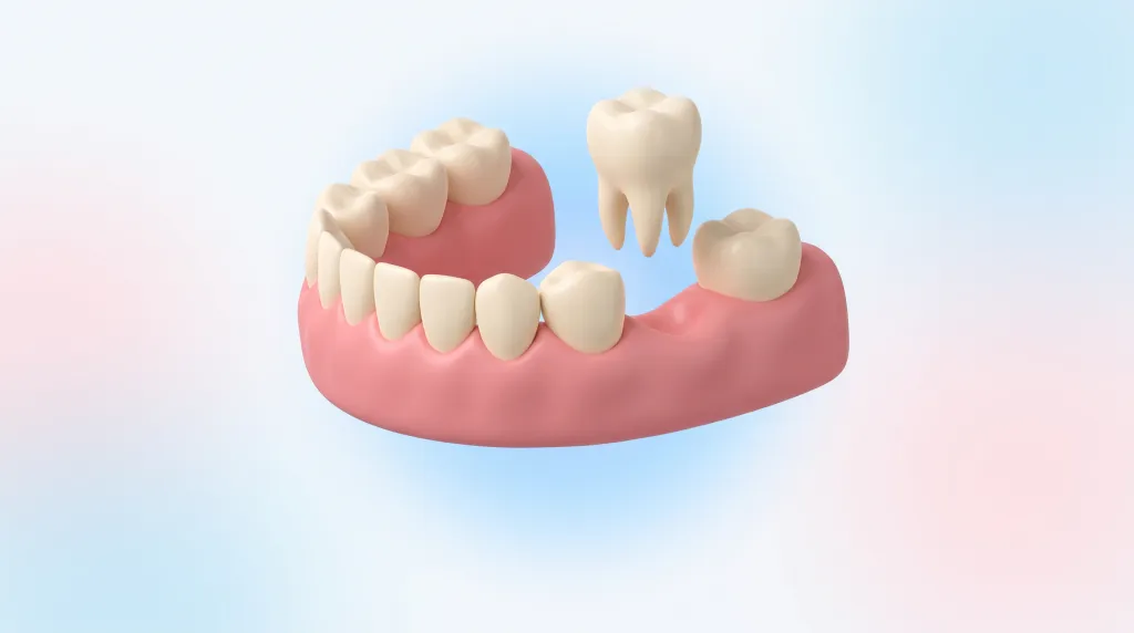 ภาพจำลองสามมิติของขากรรไกรล่างที่ฟันกรามหนึ่งซี่หลุดออกจากแนวฟัน แสดงช่องว่างที่เกิดขึ้น คลินิกทันตกรรม AuraWhite บางพลี