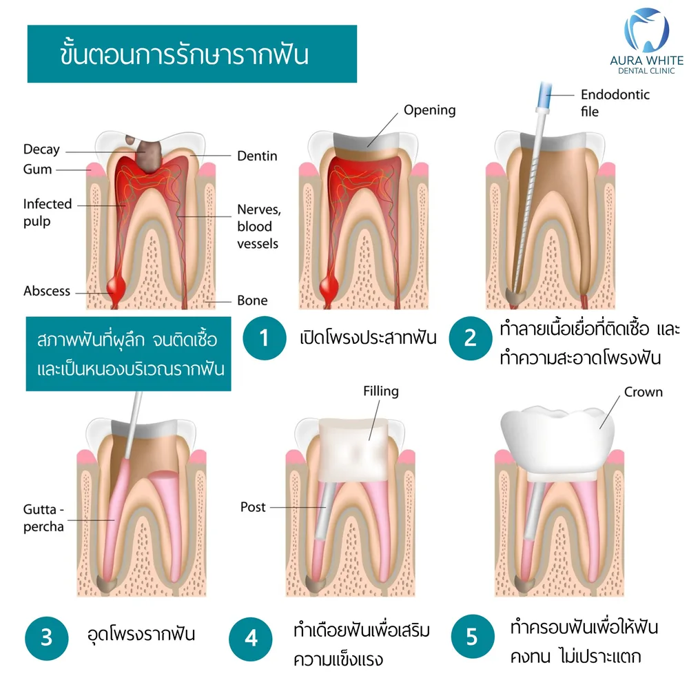 อินโฟกราฟิกขั้นตอนการรักษารากฟันห้าขั้นตอน พร้อมภาพตัดขวางฟันและครอบฟัน คลินิกทันตกรรม AuraWhite บางพลี