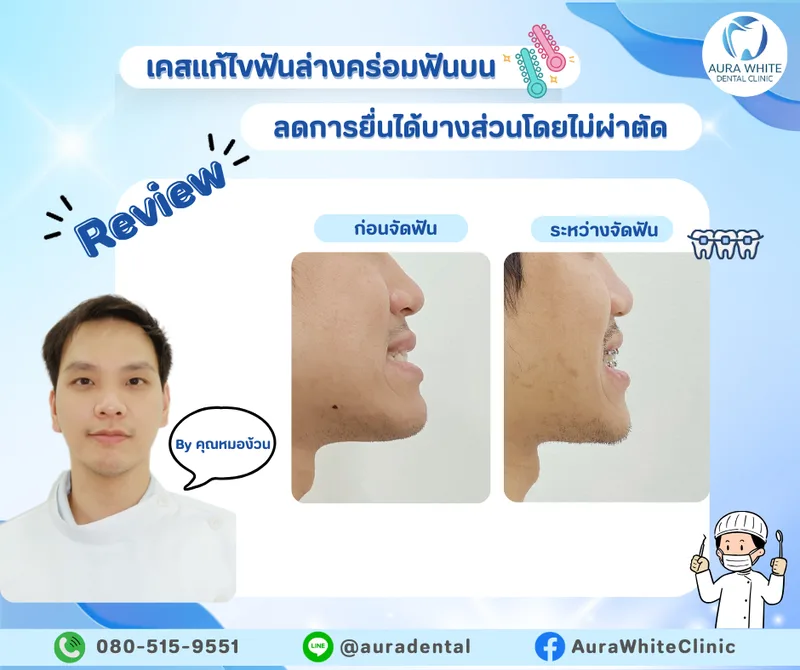 ภาพรีวิวเคสแก้ไขฟันล่างคร่อมฟันบน เปรียบเทียบใบหน้าด้านข้างก่อนและระหว่างจัดฟัน คลินิกทันตกรรม AuraWhite บางพลี