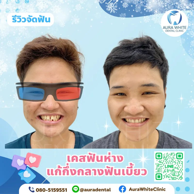 รีวิวเคสจัดฟันแก้ฟันห่างและฟันเบี้ยว ภาพใบหน้าคนไข้ก่อนและหลังจัดฟัน คลินิกทันตกรรม AuraWhite บางพลี